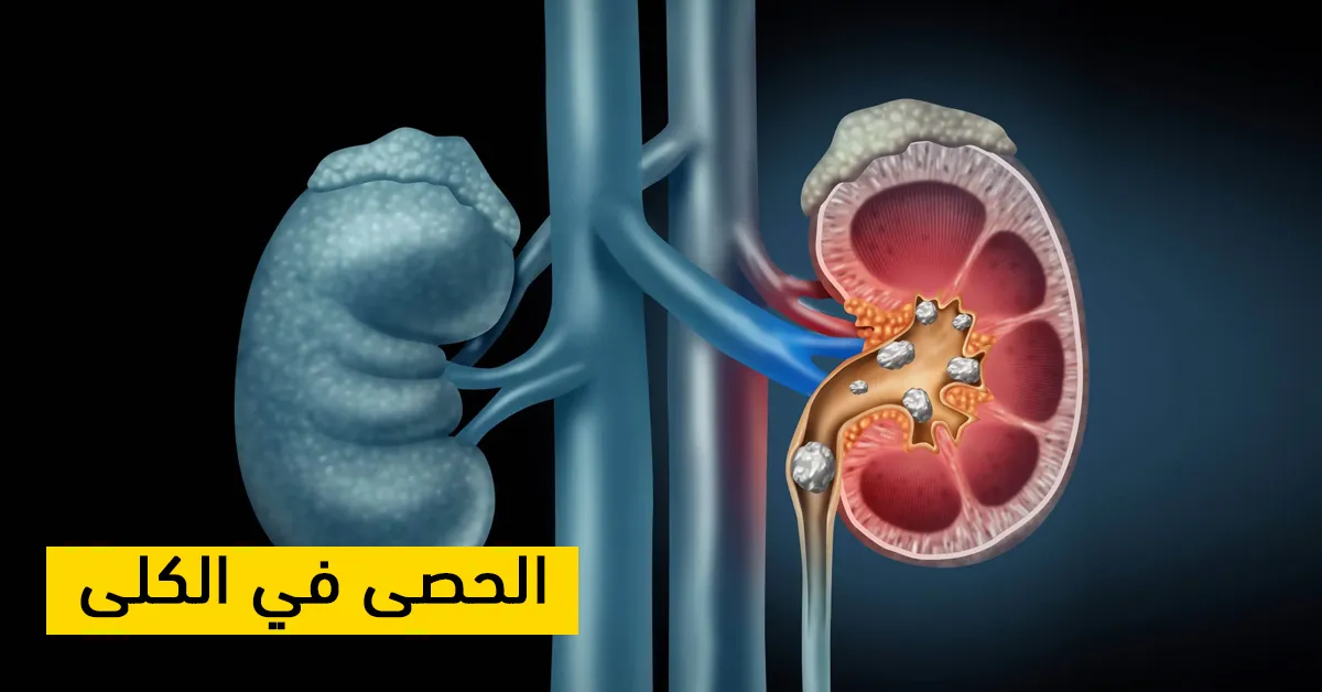 الحصى في الكلى